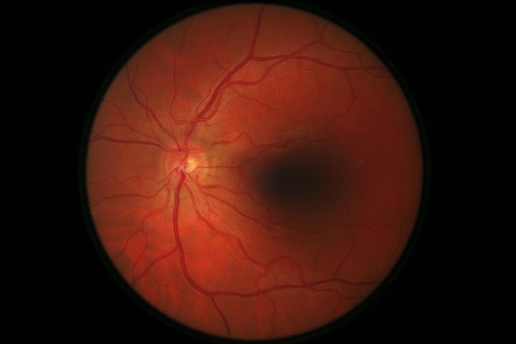 Baxter Taps Digital Diagnostics' Diabetic Retinopathy AI for its Welch Allyn Eye Scanners