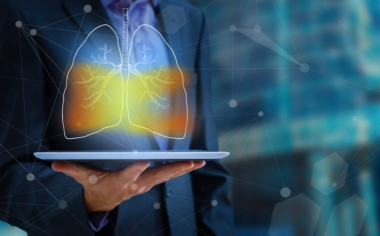 AI Solution to Detect Lung Cancer Launches in South West England