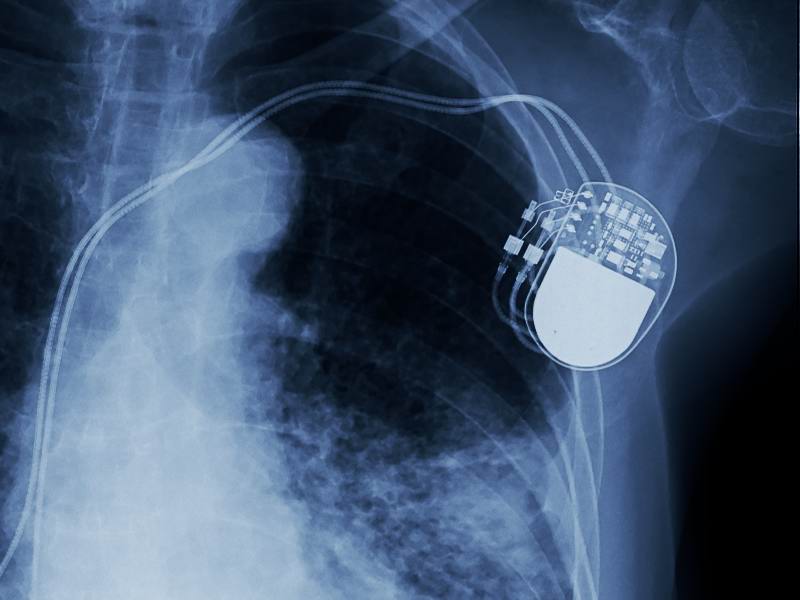 750,000 Medtronic Defibrillators Vulnerable to Hacking