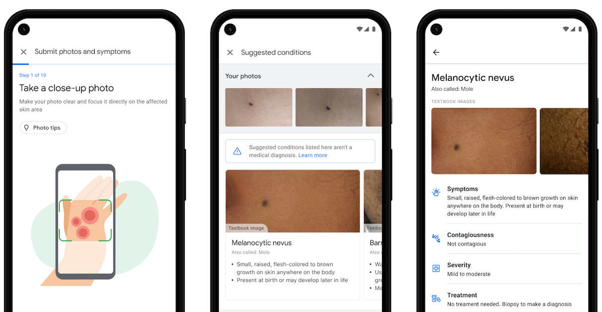 Google Gives a Sneak Peek into its New AI Dermatology Assistant