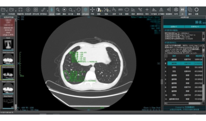 Ping An’s COVID-19 Smart Image Reading System speeds up diagnoses and treatment