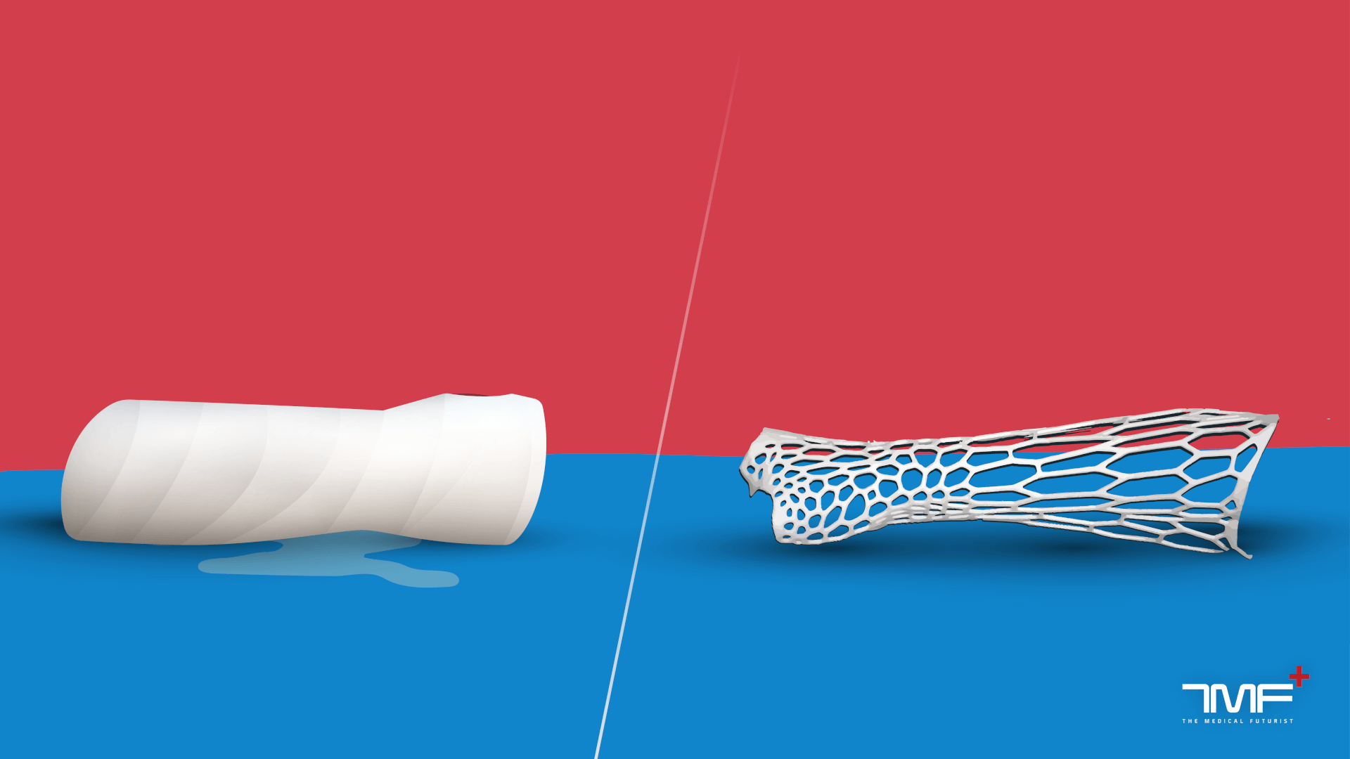Where Are 3D-Printed Casts?