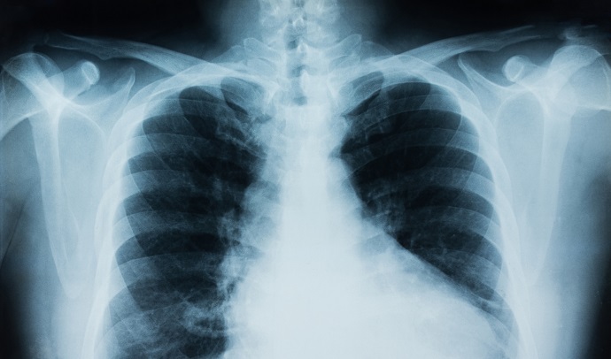 Artificial Intelligence System Analyzes Chest X-Rays in 10 Seconds