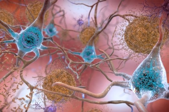A comprehensive map of how Alzheimer's affects the brain: Analysis of genes altered by the disease …
