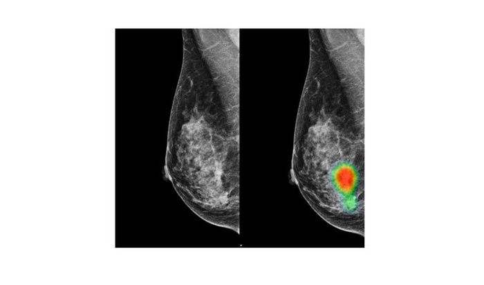 AI helps radiologists improve accuracy in breast cancer detection with lesser recalls