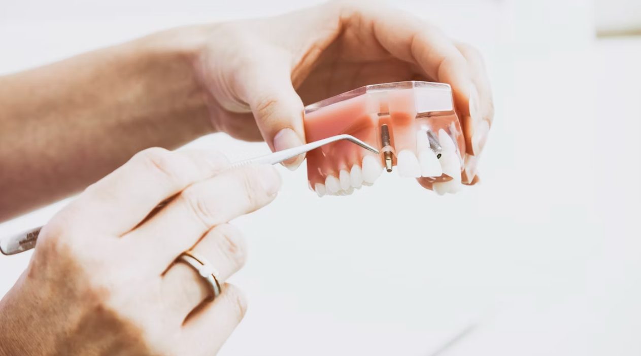 What Makes Dental Implants a Game-Changer in Modern Oral Surgery?