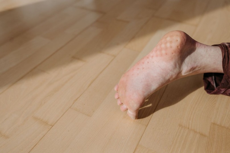Cracked Heels in Ontario: Causes, Prevention, and Treatment