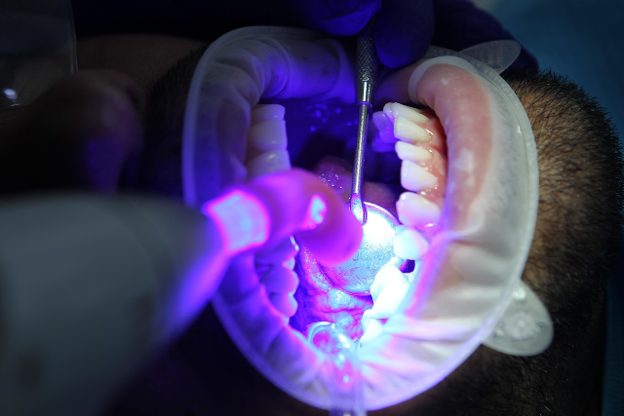 How Much Does Teeth Whitening Really Cost