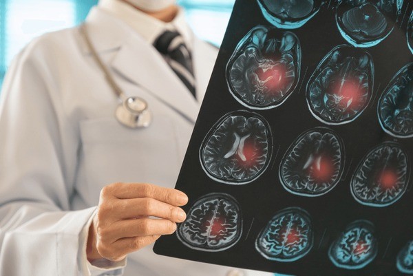 Why Brain Injury Cases Demand Strong Legal Expertise