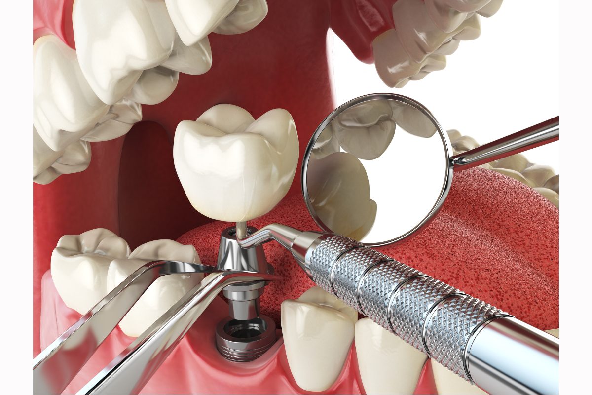 Is It Safe to Have Dental Implants in Turkey?