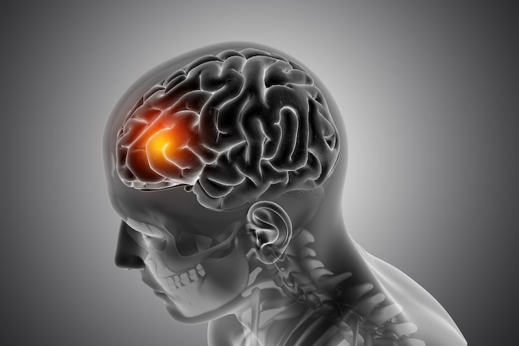 What Makes Traumatic Brain Injury Claims in Riverside So Difficult to Value