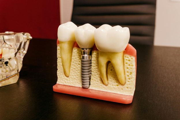 Types of Dental Implant Services: Which One Is Right for You?