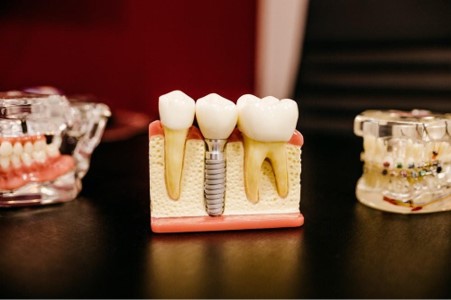 Building a Digital Dentistry Stack: From Scanners to Same-Day Crowns