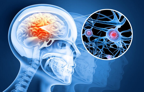 What You Should Know About Brain Injuries