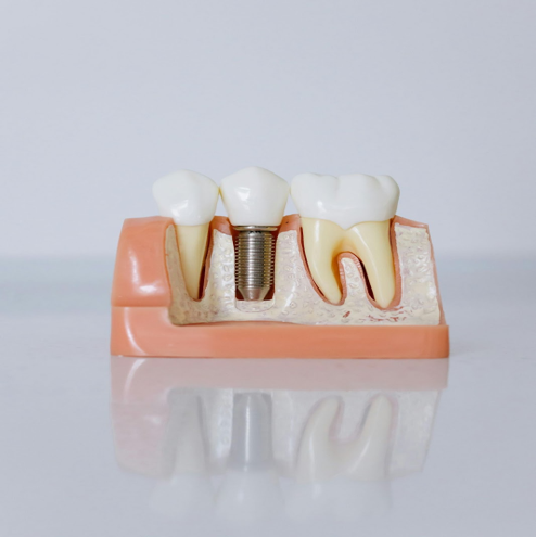 What Are Full-Arch Dental Implants