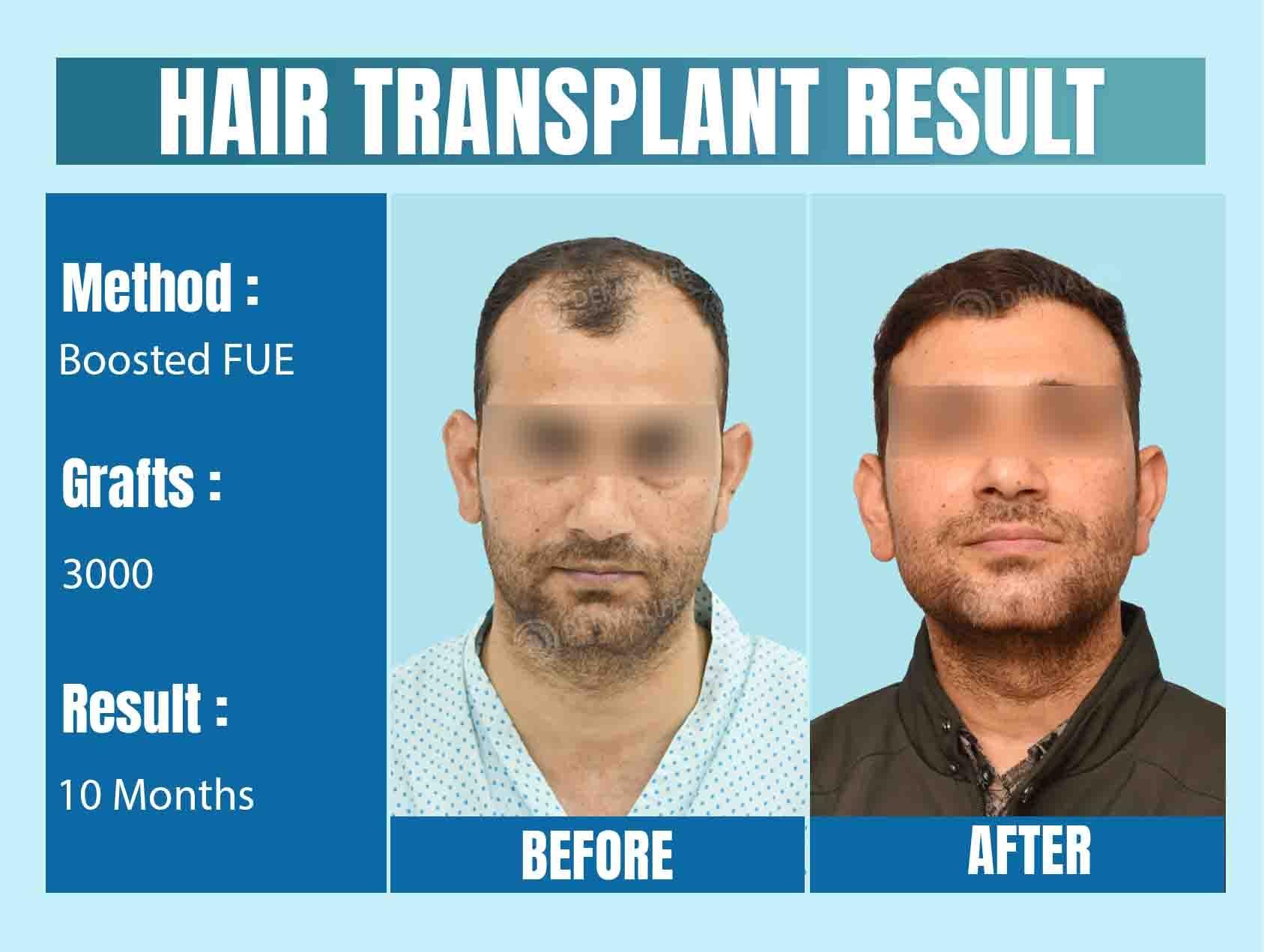 Do the Skills of the Surgeon Affect the Results of a Hair Transplant?