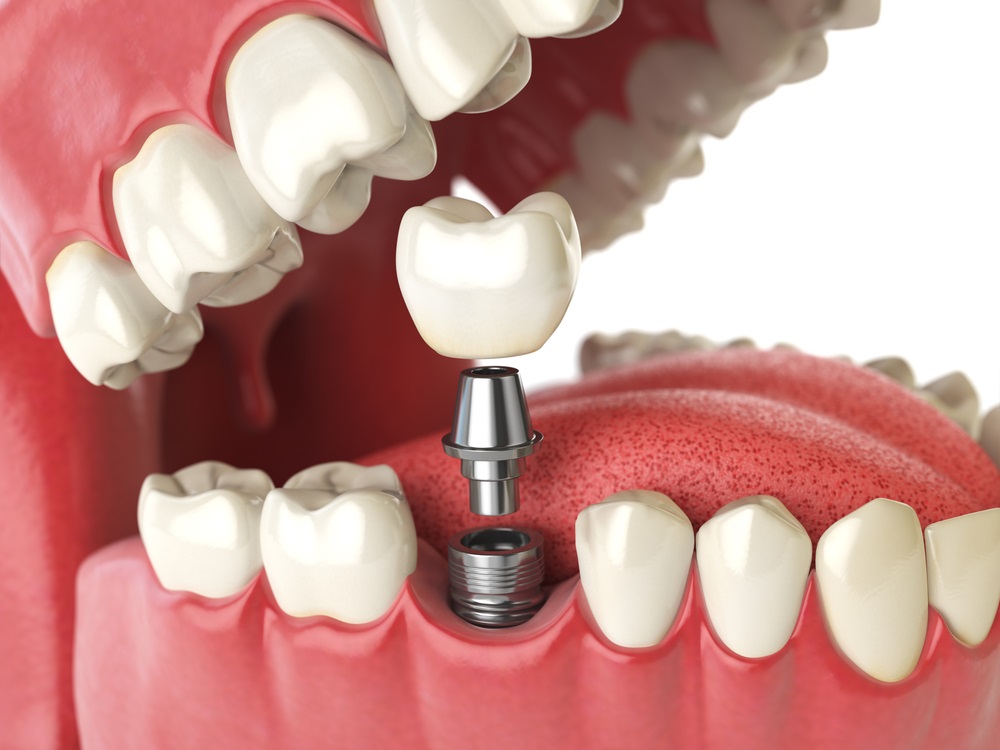 Can AI Improve Dental Implant Planning? What the Technology Can and Can’t Do