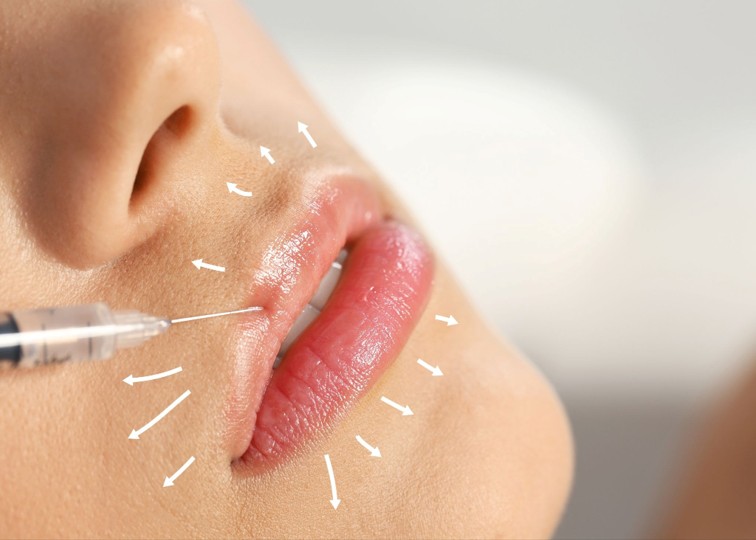 Different Types of Lip Fillers and the Technologies Behind Them