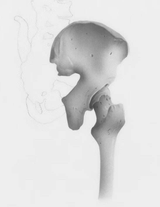 Ceramic vs Metal Hip Replacement Implants: What Is the Difference?