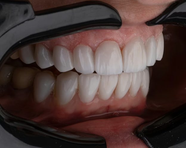 Smile Boldly Again: The Functional and Aesthetic Power of Dental Implants