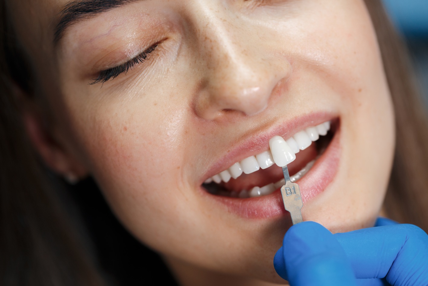 Considering Veneers? What Woodbridge Patients Should Know