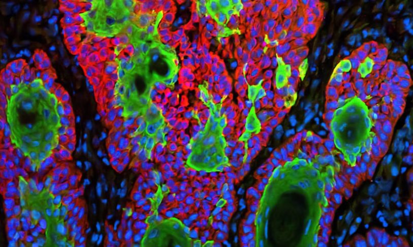 4 Emerging Therapies That Are Revolutionizing Skin Cancer Treatment in 2025