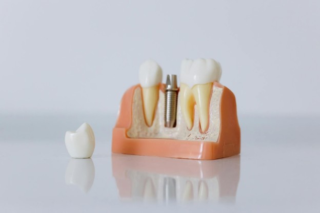 Dental Implants: How They Replace Missing Teeth Permanently