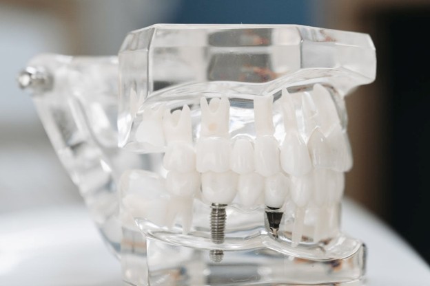 Affordable Dental Implant Solutions for Your Smile Needs