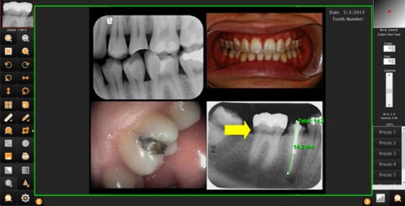 Televere's Dental Digital X-Ray