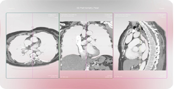 RapidAI - Cardiac & Vascular Solutions