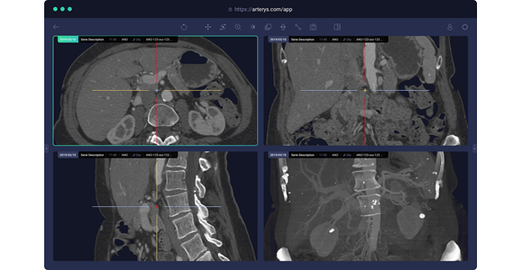 Arterys Viewer AI