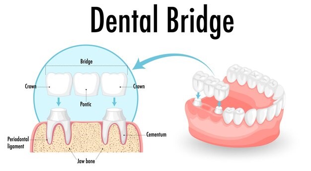 Med-Tech Revolution Dental Bridges in Turkey