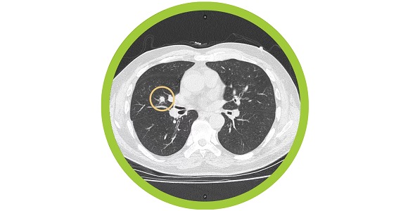 Optellum's Lung Cancer Prediction AI