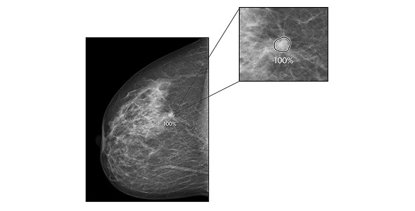 ProFound AI™ for 2D Mammography