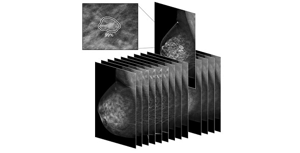 ProFound AI™  for Digital Breast Tomosynthesis